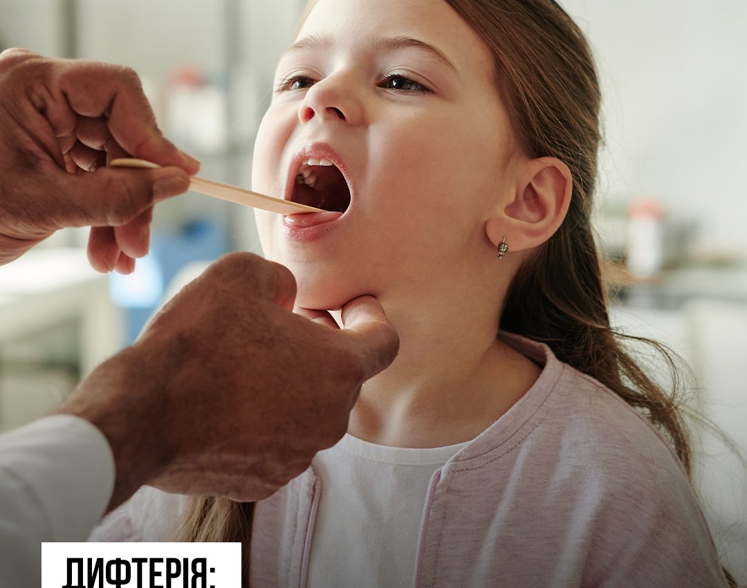 Дифтерія: чим небезпечна, які симптоми та чому варто щепитися за Календарем щеплень