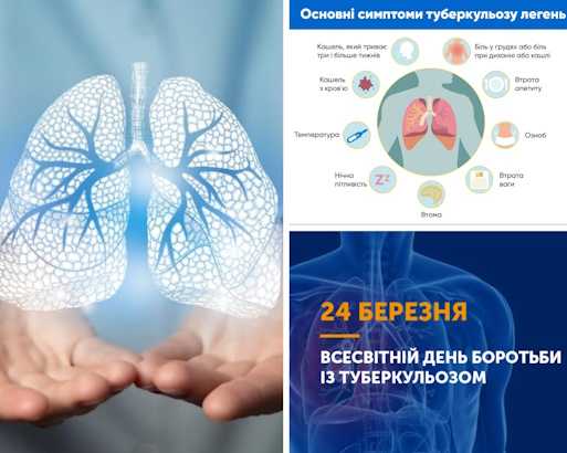 Так! Ми можемо подолати туберкульоз