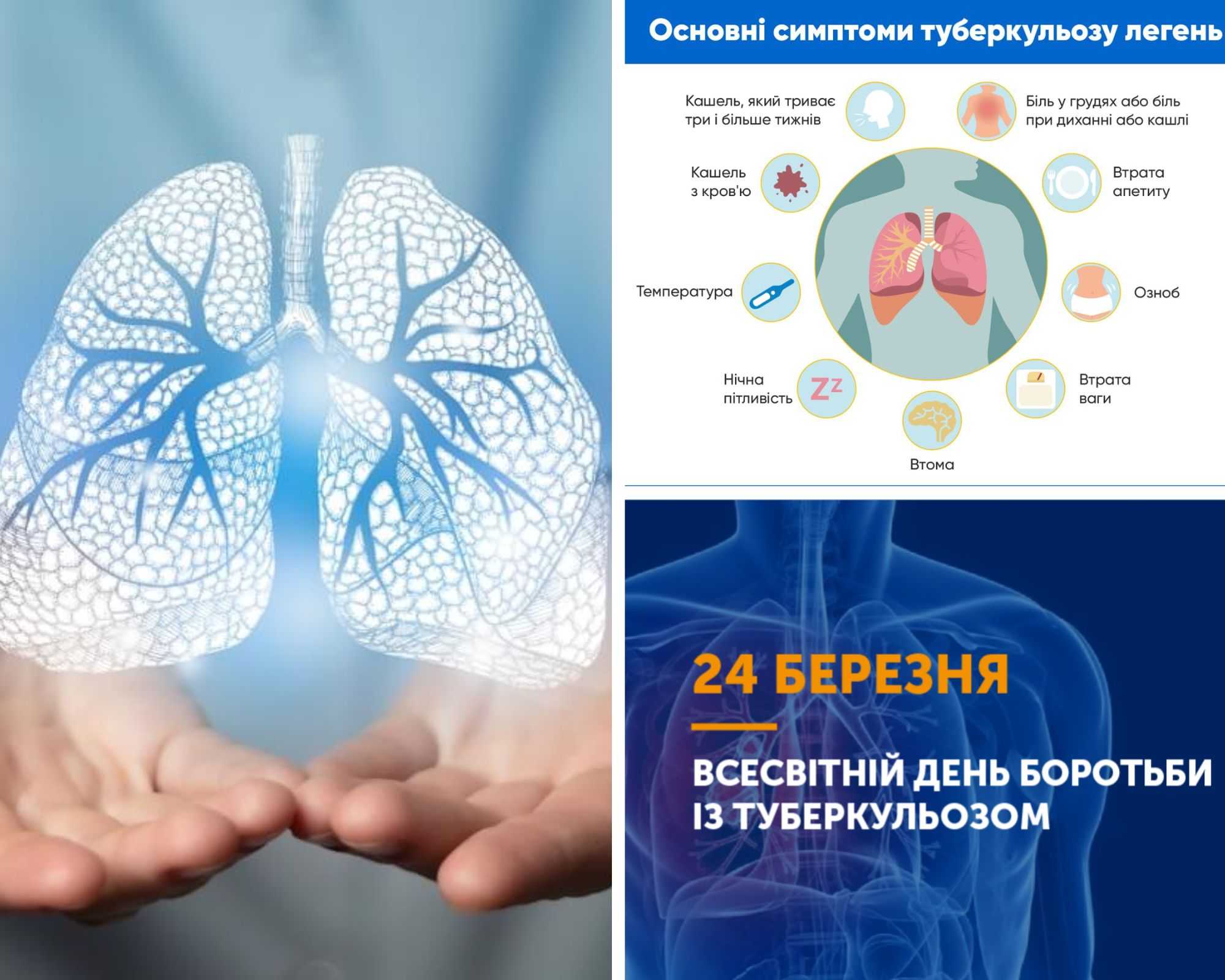 Так! Ми можемо подолати туберкульоз